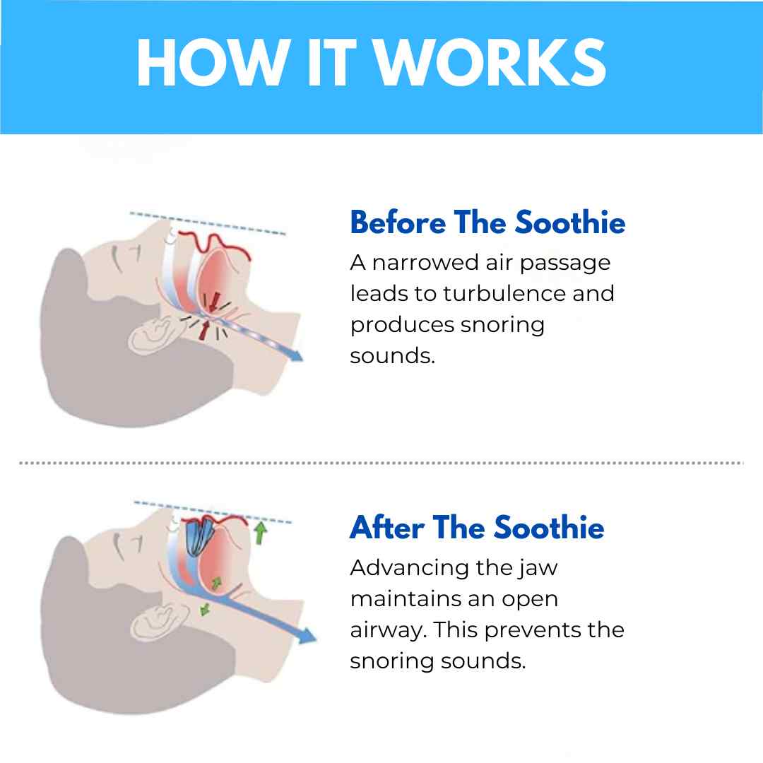 THE SOOTHIE™ ANTI SNORING MOUTHPIECE